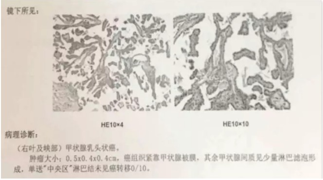 別慌，甲狀腺疾病還可以這樣投保！