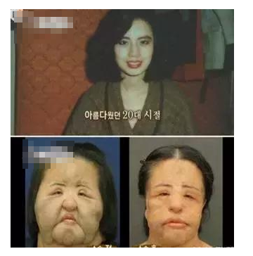 整容發(fā)生意外保險賠嗎？